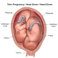 Illustration of a twin birth, head down/head down 