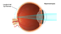 Ilustración sobre la hipermetropía